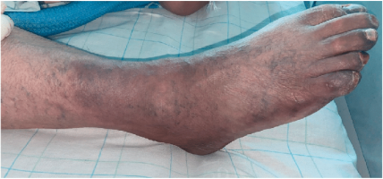 Cyanotic-right-foot-showing-the-acute-limb-ischemia.png